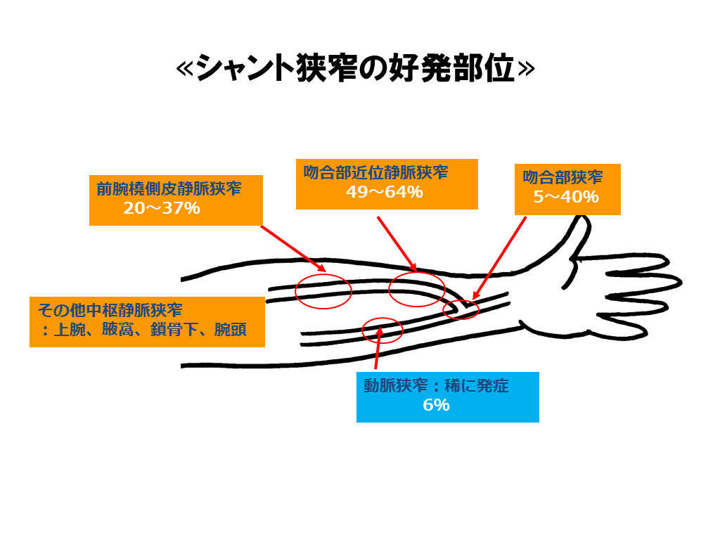 シャント狭窄の好発部位