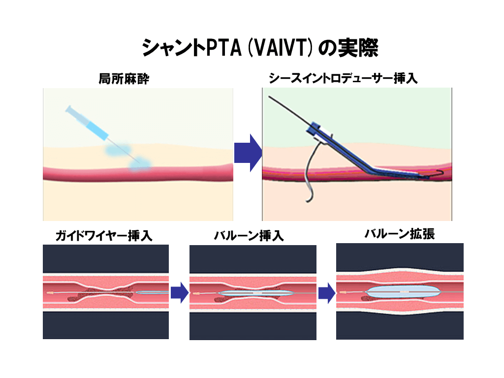 シャントPTA(VAIVT)の実際