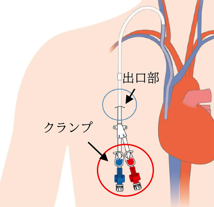 透析用長期留置カテーテル挿入術
